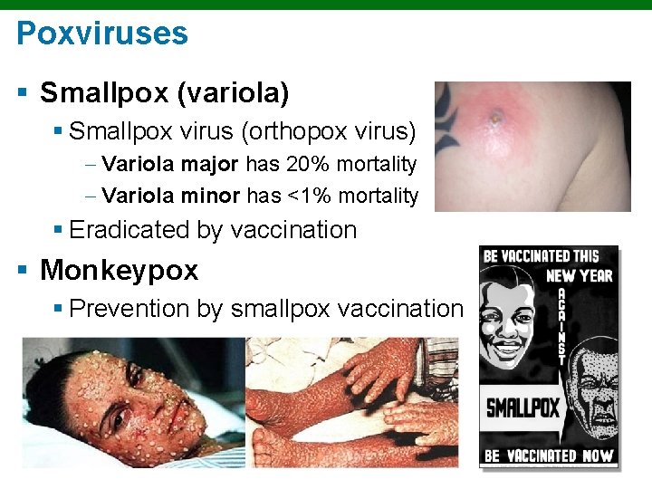 Poxviruses § Smallpox (variola) § Smallpox virus (orthopox virus) Variola major has 20% mortality
