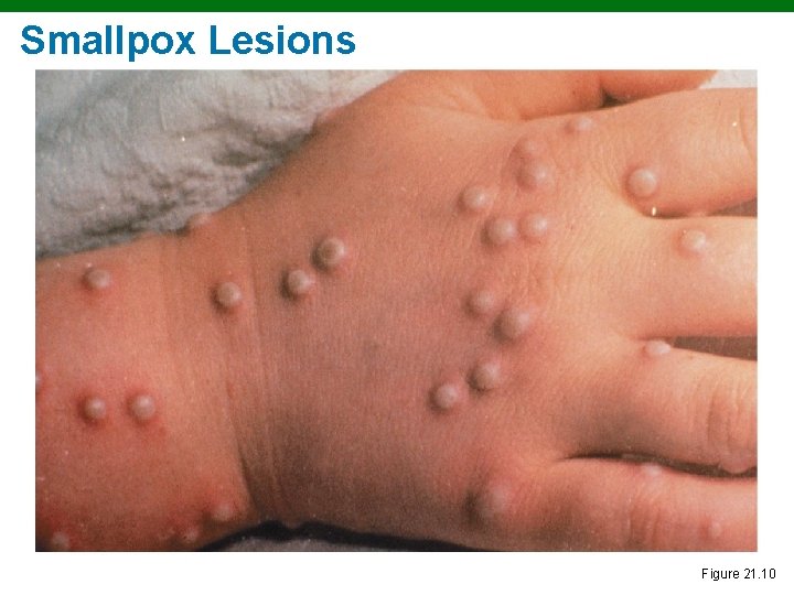 Smallpox Lesions Figure 21. 10 
