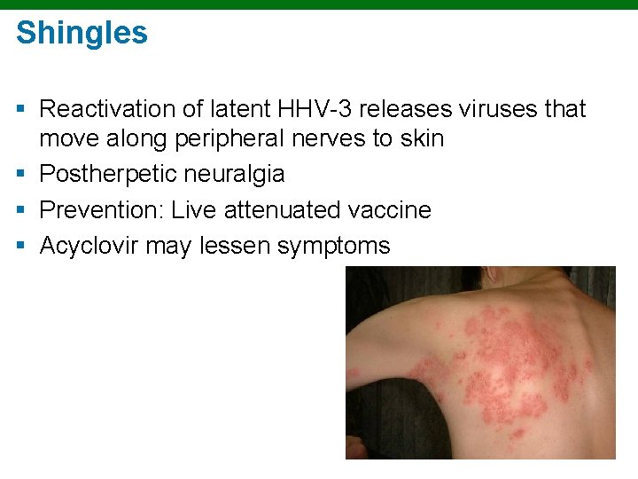 Shingles § Reactivation of latent HHV-3 releases viruses that move along peripheral nerves to