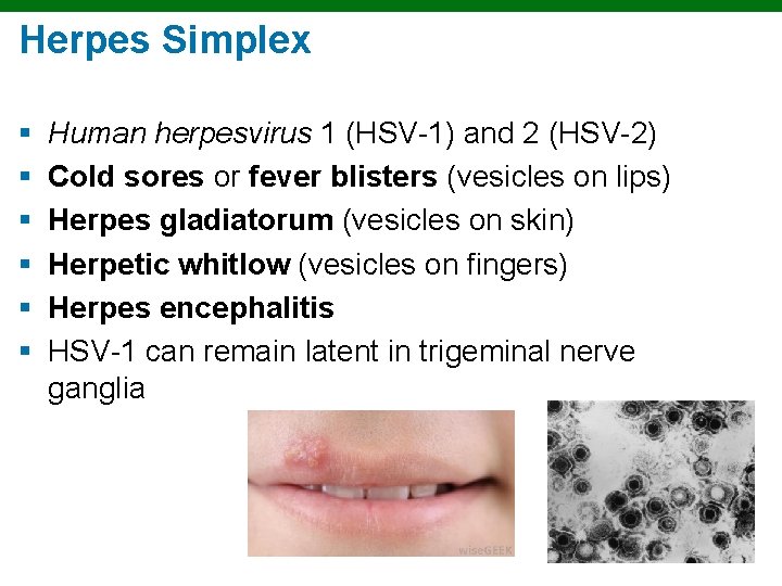 Herpes Simplex § § § Human herpesvirus 1 (HSV-1) and 2 (HSV-2) Cold sores