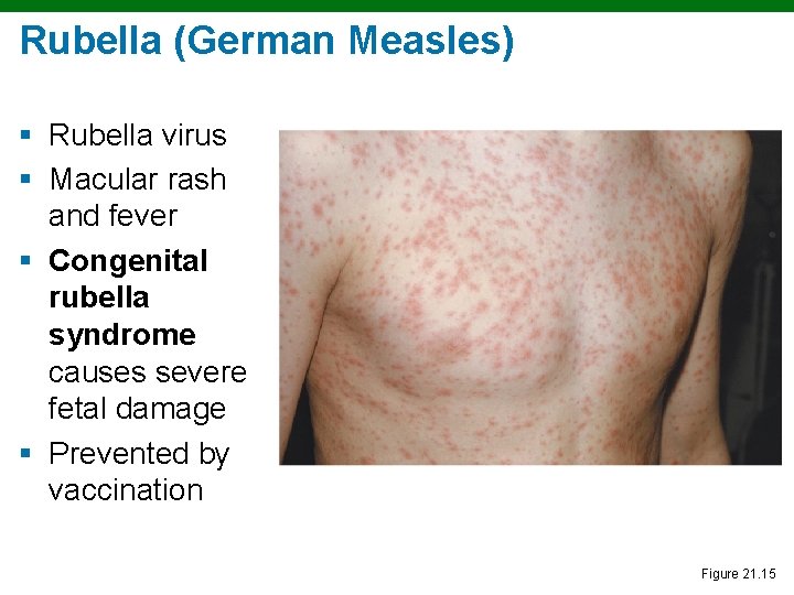 Rubella (German Measles) § Rubella virus § Macular rash and fever § Congenital rubella