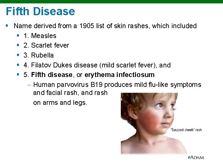 Fifth Disease § Name derived from a 1905 list of skin rashes, which included