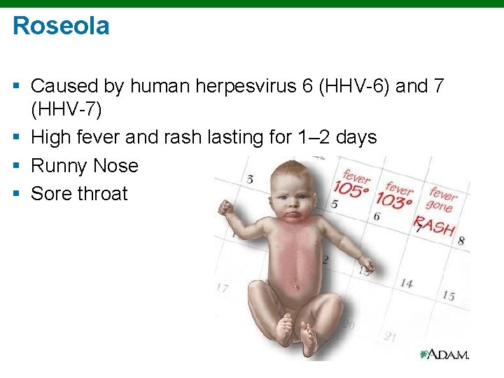Roseola § Caused by human herpesvirus 6 (HHV-6) and 7 (HHV-7) § High fever
