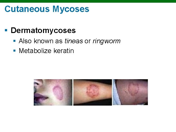 Cutaneous Mycoses § Dermatomycoses § Also known as tineas or ringworm § Metabolize keratin