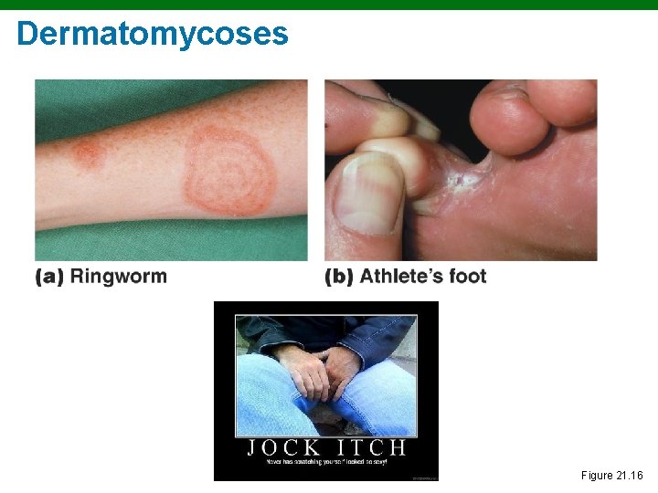Dermatomycoses Figure 21. 16 Dermatomycoses Figure 21. 16