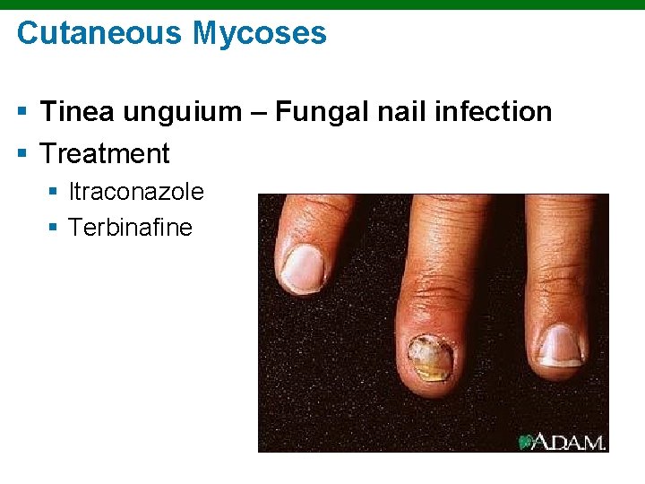 Cutaneous Mycoses § Tinea unguium – Fungal nail infection § Treatment § Itraconazole §