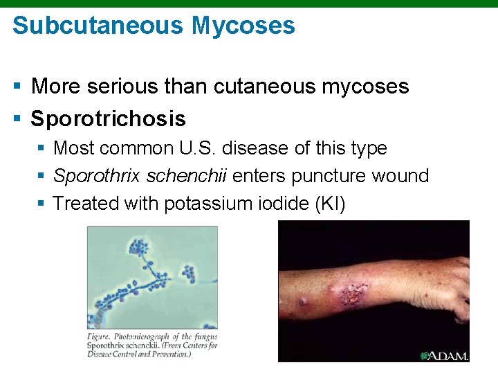 Subcutaneous Mycoses § More serious than cutaneous mycoses § Sporotrichosis § Most common U.