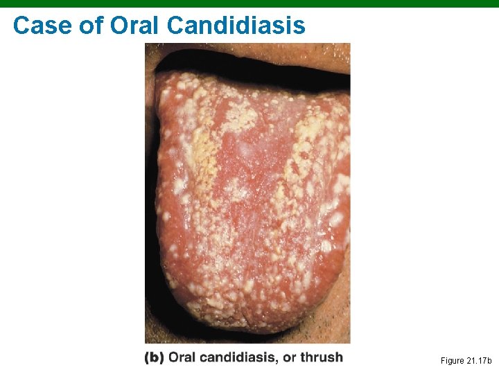 Case of Oral Candidiasis Figure 21. 17 b 