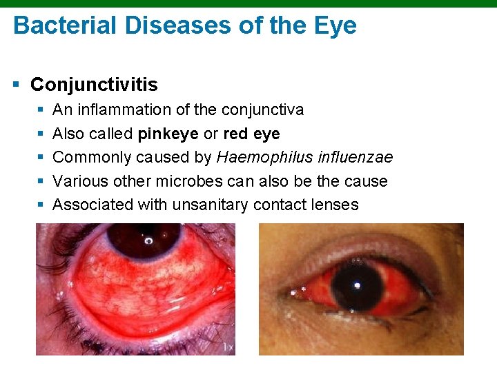 Bacterial Diseases of the Eye § Conjunctivitis § § § An inflammation of the