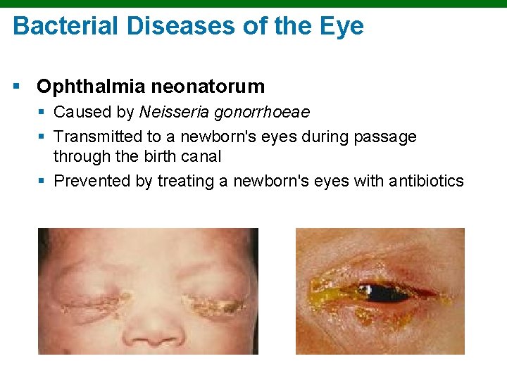 Bacterial Diseases of the Eye § Ophthalmia neonatorum § Caused by Neisseria gonorrhoeae §