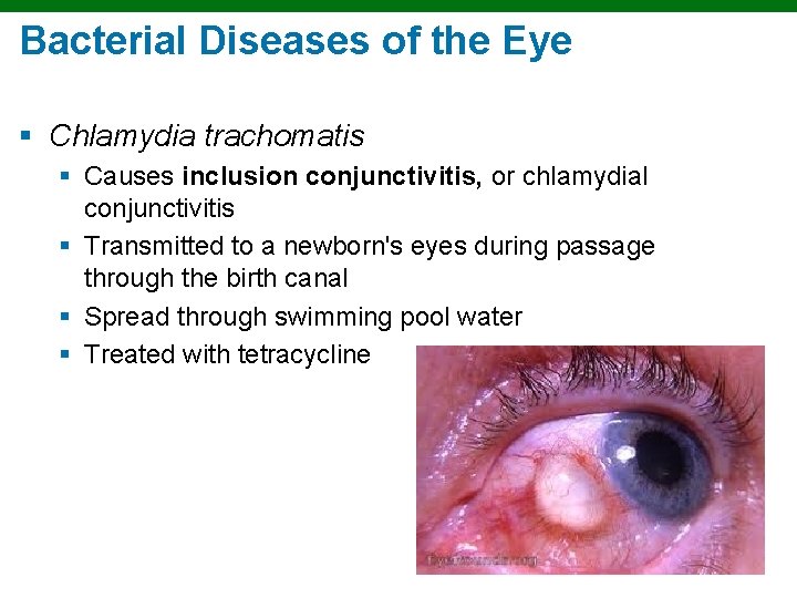 Bacterial Diseases of the Eye § Chlamydia trachomatis § Causes inclusion conjunctivitis, or chlamydial Bacterial Diseases of the Eye § Chlamydia trachomatis § Causes inclusion conjunctivitis, or chlamydial