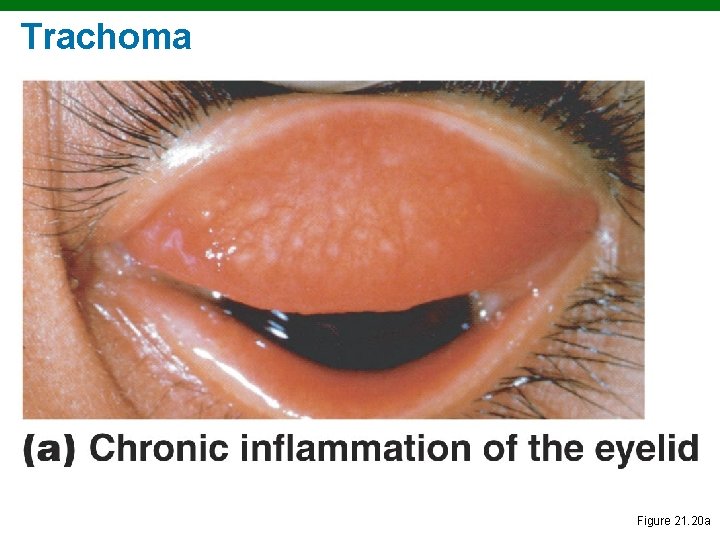 Trachoma Figure 21. 20 a 