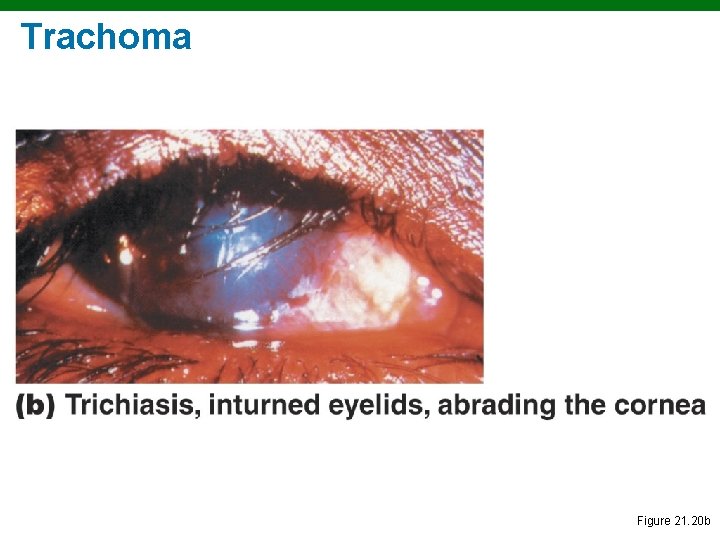 Trachoma Figure 21. 20 b 