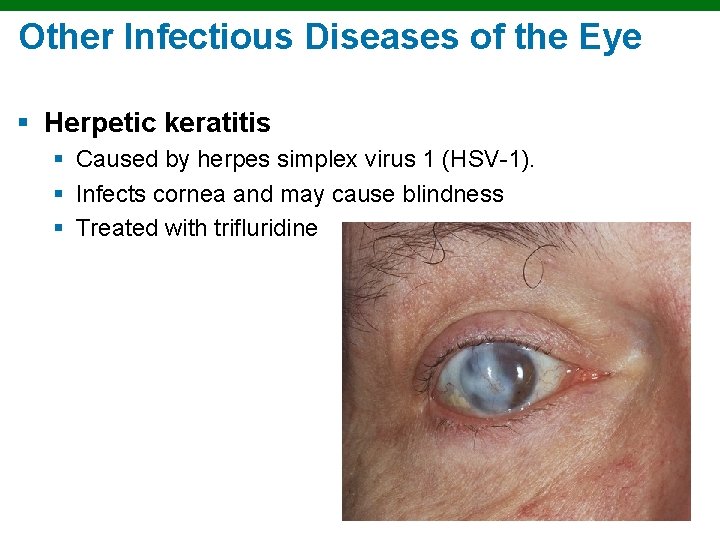 Other Infectious Diseases of the Eye § Herpetic keratitis § Caused by herpes simplex