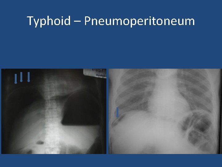 Typhoid – Pneumoperitoneum 