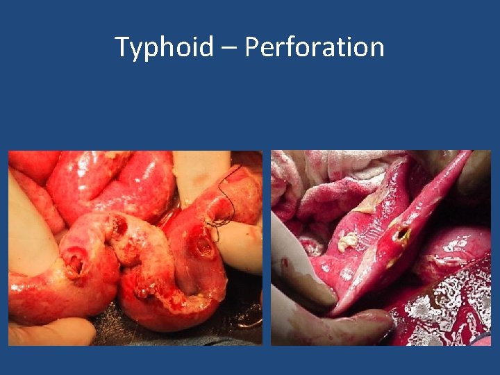 Typhoid – Perforation 
