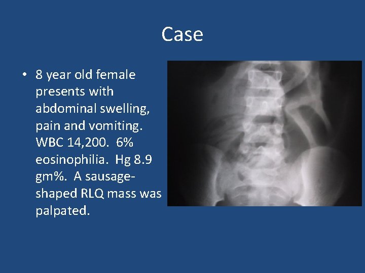 Case • 8 year old female presents with abdominal swelling, pain and vomiting. WBC