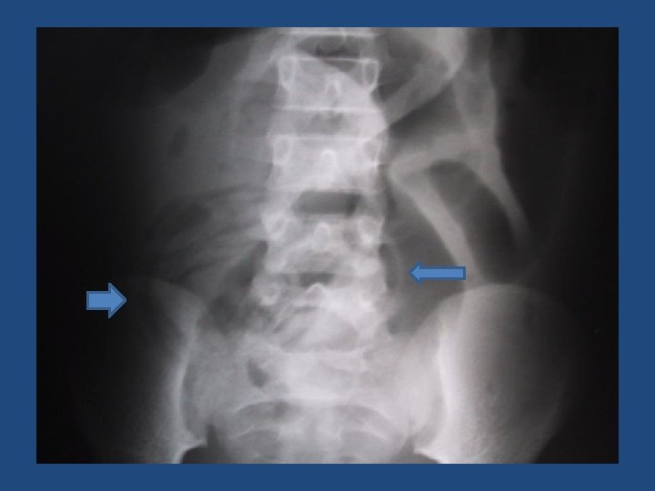 Ascariasis & Volvulus - Xray 