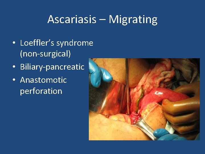 Ascariasis – Migrating • Loeffler’s syndrome (non-surgical) • Biliary-pancreatic • Anastomotic perforation 