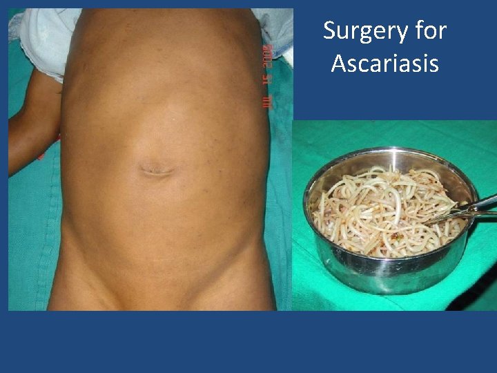 Surgery for Ascariasis 