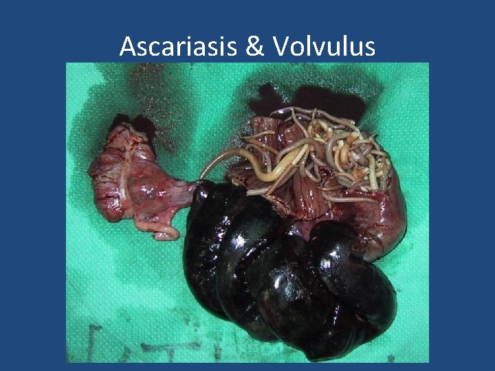 Ascariasis & Volvulus 