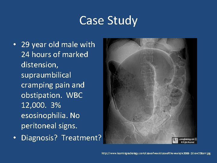 Case Study • 29 year old male with 24 hours of marked distension, supraumbilical