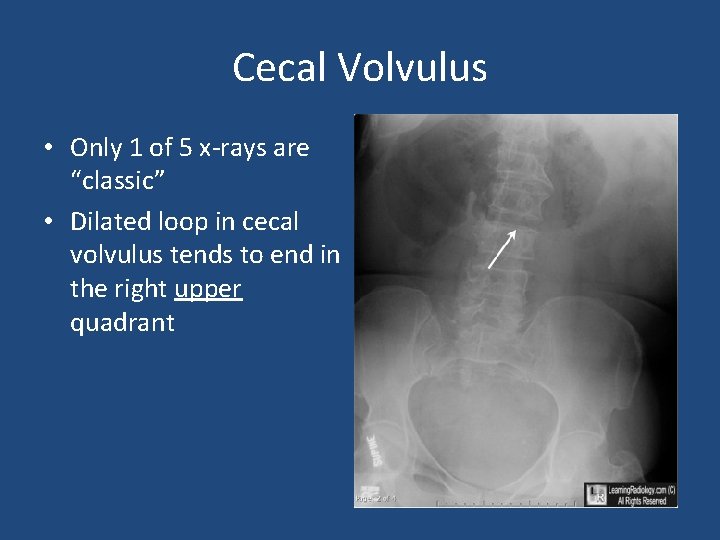 Cecal Volvulus • Only 1 of 5 x-rays are “classic” • Dilated loop in