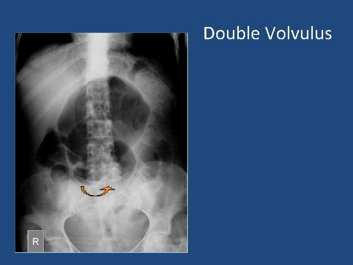 Double Volvulus 