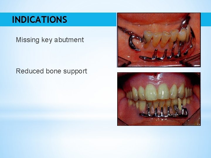 INDICATIONS Missing key abutment Reduced bone support 