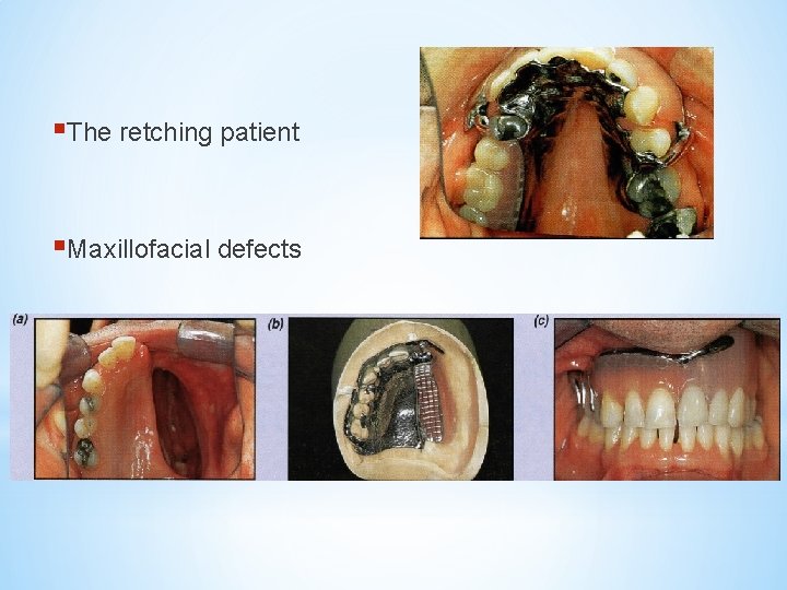 §The retching patient §Maxillofacial defects 