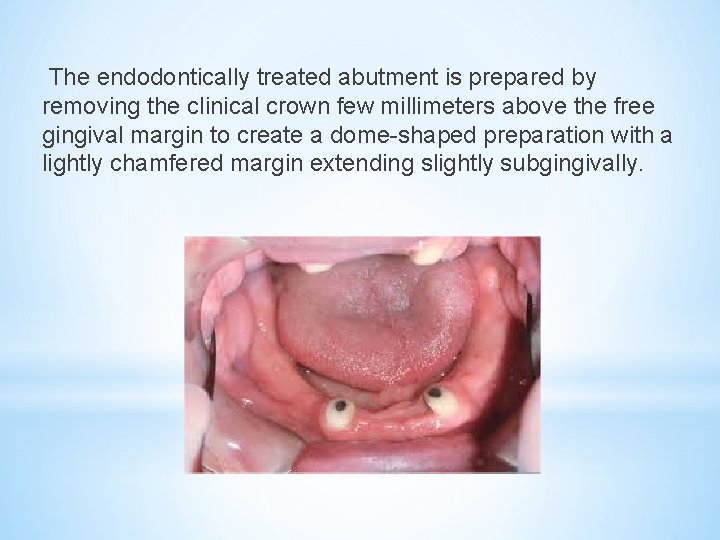 The endodontically treated abutment is prepared by removing the clinical crown few millimeters above