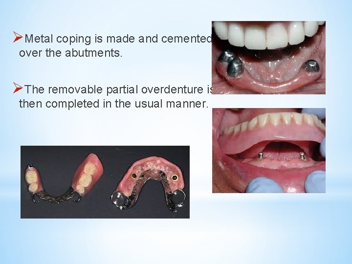 ØMetal coping is made and cemented over the abutments. ØThe removable partial overdenture is