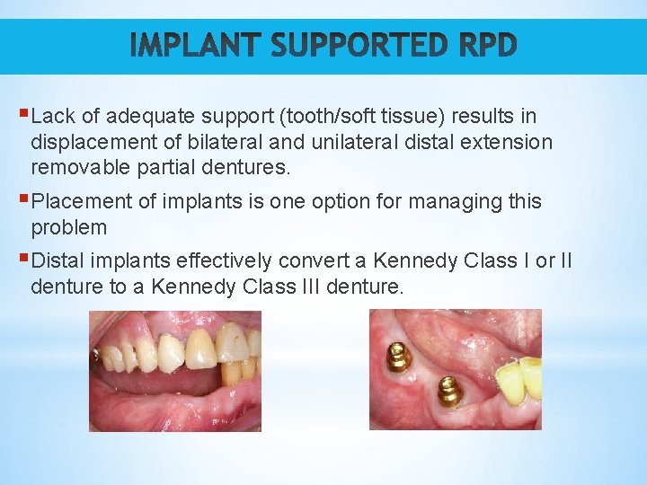 §Lack of adequate support (tooth/soft tissue) results in displacement of bilateral and unilateral distal