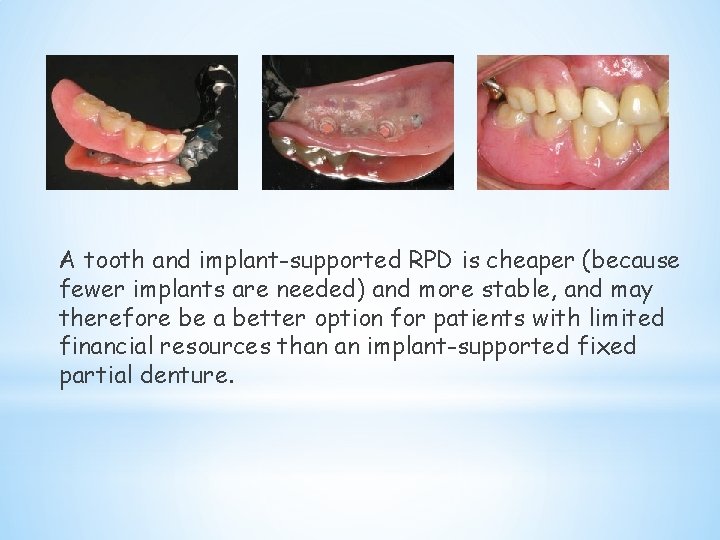 A tooth and implant-supported RPD is cheaper (because fewer implants are needed) and more