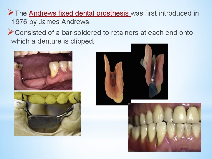 ØThe Andrews fixed dental prosthesis was first introduced in 1976 by James Andrews, ØConsisted