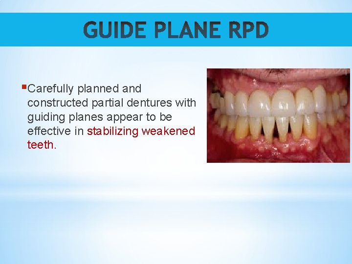 §Carefully planned and constructed partial dentures with guiding planes appear to be effective in