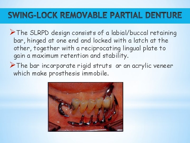 ØThe SLRPD design consists of a labial/buccal retaining bar, hinged at one end and