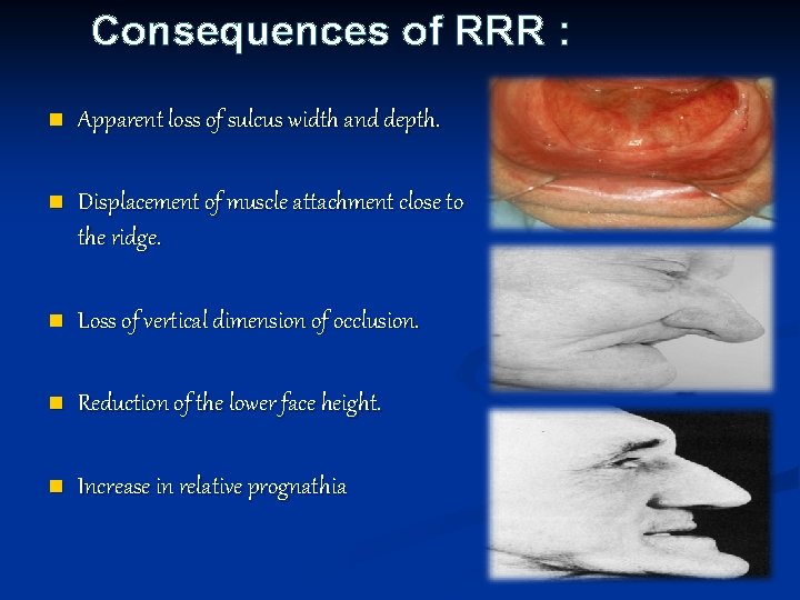 Consequences of RRR : n Apparent loss of sulcus width and depth. n Displacement