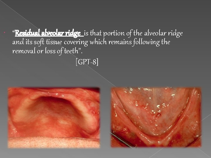  “Residual alveolar ridge is that portion of the alveolar ridge and its soft