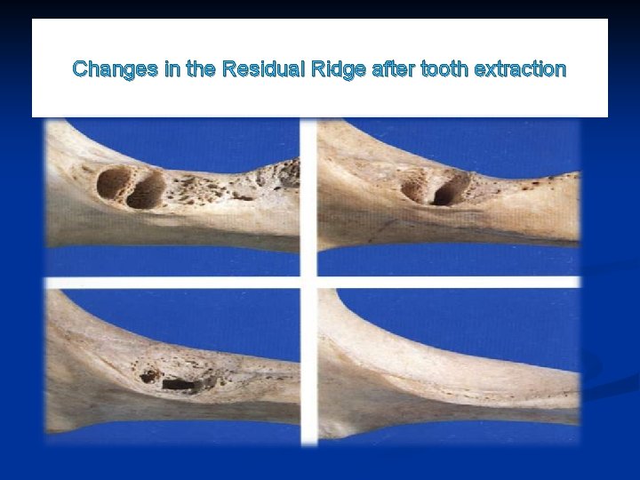 Changes in the Residual Ridge after tooth extraction 