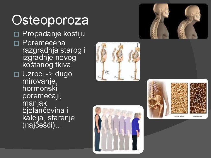 Osteoporoza Propadanje kostiju Poremećena razgradnja starog i izgradnje novog koštanog tkiva � Uzroci ->