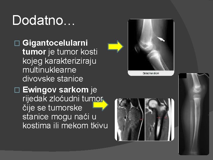 Dodatno… Gigantocelularni tumor je tumor kosti kojeg karakteriziraju multinuklearne divovske stanice � Ewingov sarkom