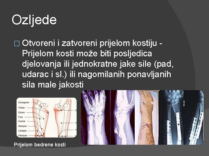 Ozljede � Otvoreni i zatvoreni prijelom kostiju - Prijelom kosti može biti posljedica djelovanja