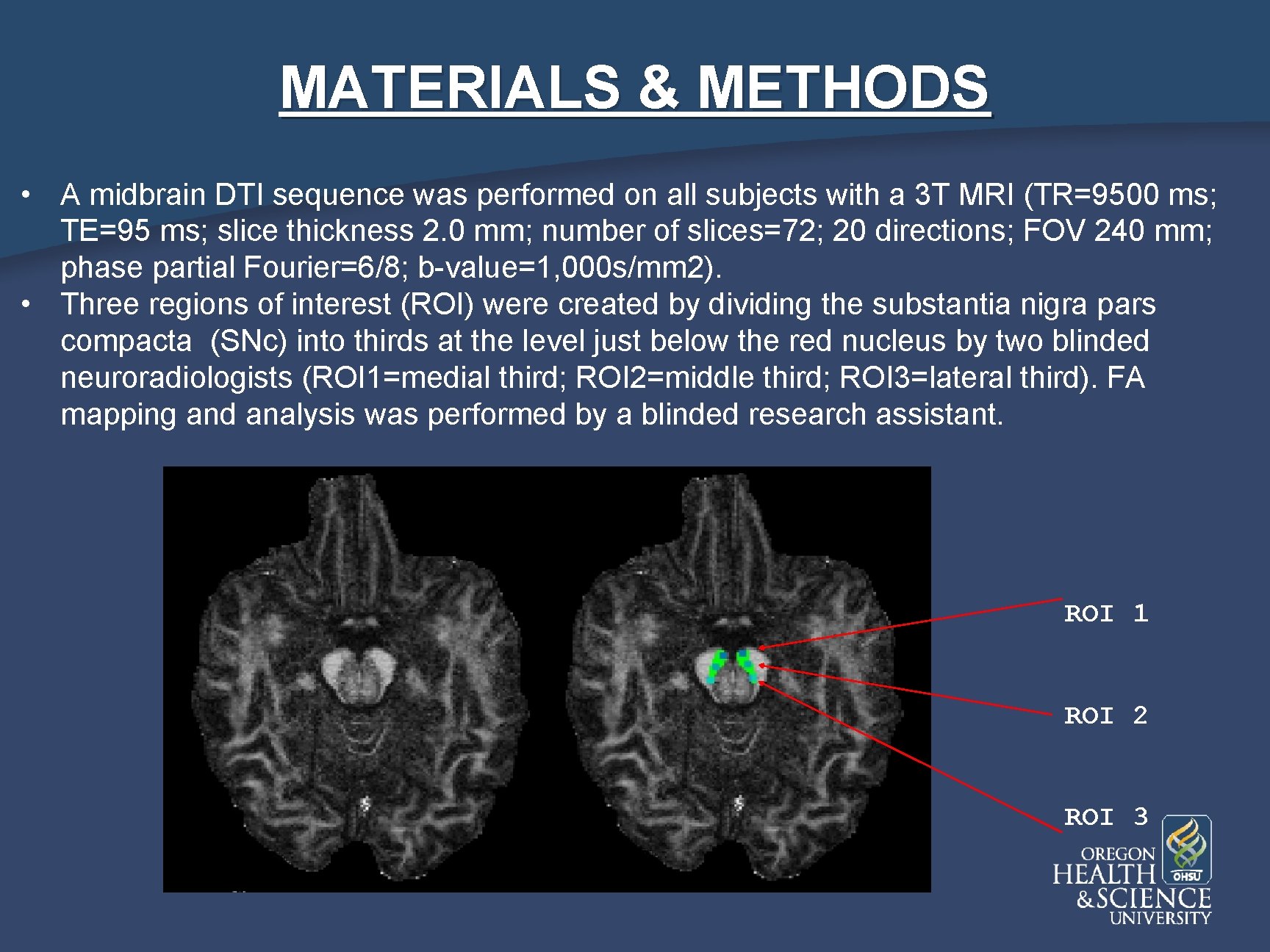 MATERIALS & METHODS • A midbrain DTI sequence was performed on all subjects with