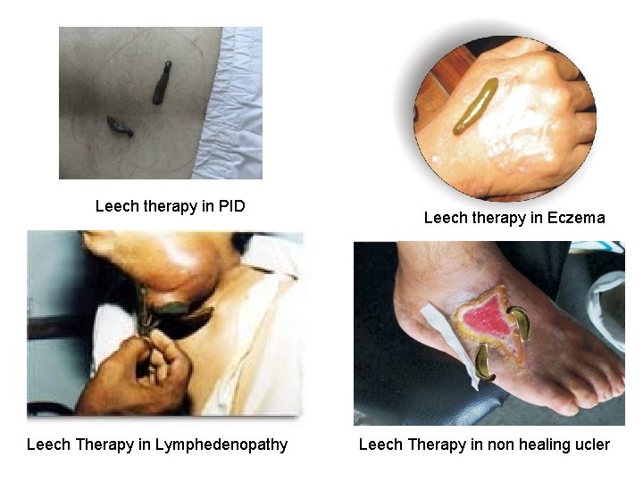 Leech therapy in PID Leech Therapy in Lymphedenopathy Leech therapy in Eczema Leech Therapy