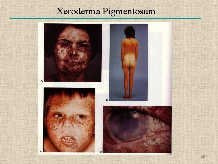 Xeroderma Pigmentosum 39 
