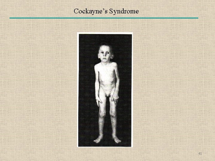Cockayne’s Syndrome 41 