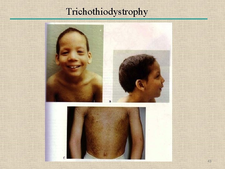 Trichothiodystrophy 43 