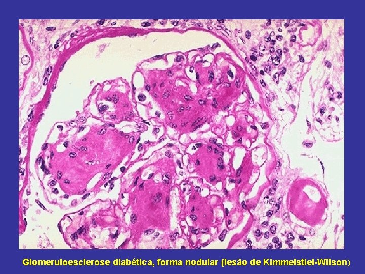 Glomeruloesclerose diabética, forma nodular (lesão de Kimmelstiel-Wilson) 