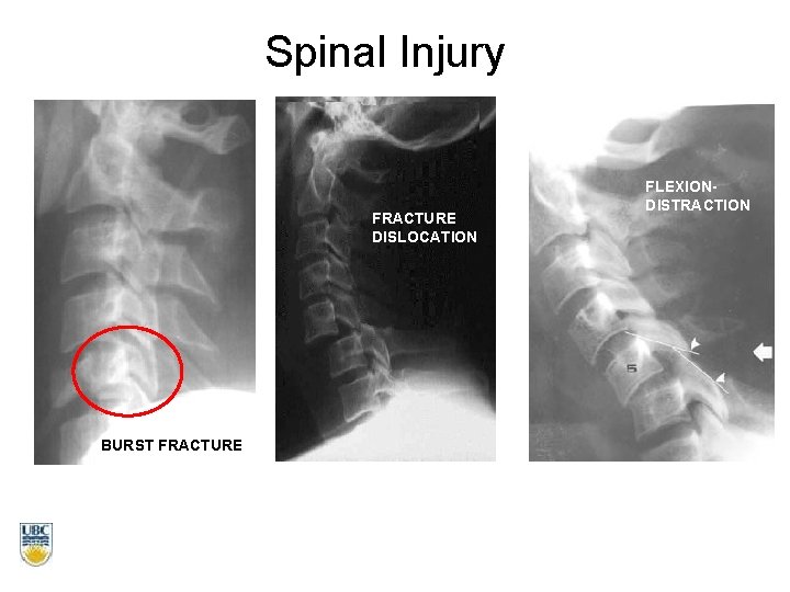 Spinal Injury FRACTURE DISLOCATION BURST FRACTURE FLEXIONDISTRACTION 